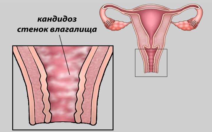Кандидоз стенок влагалища