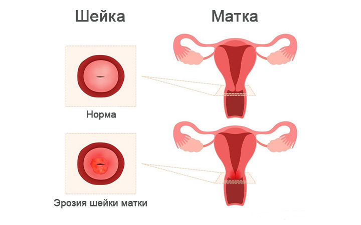 Эрозия шейки матки схема